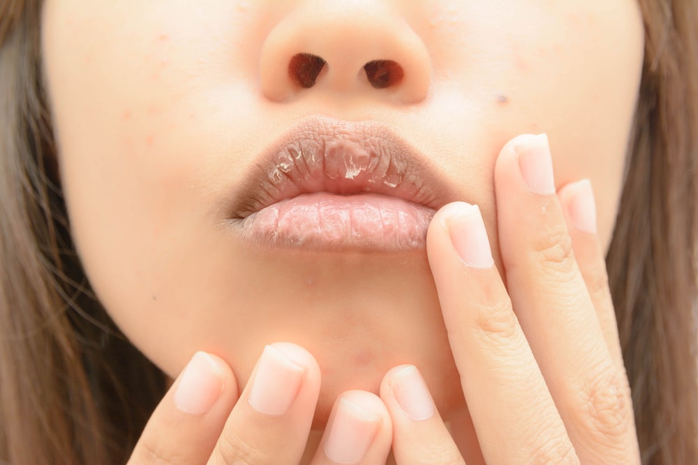  Lábios ressecados: 6 dicas para ter lábios perfeitos e hidratados