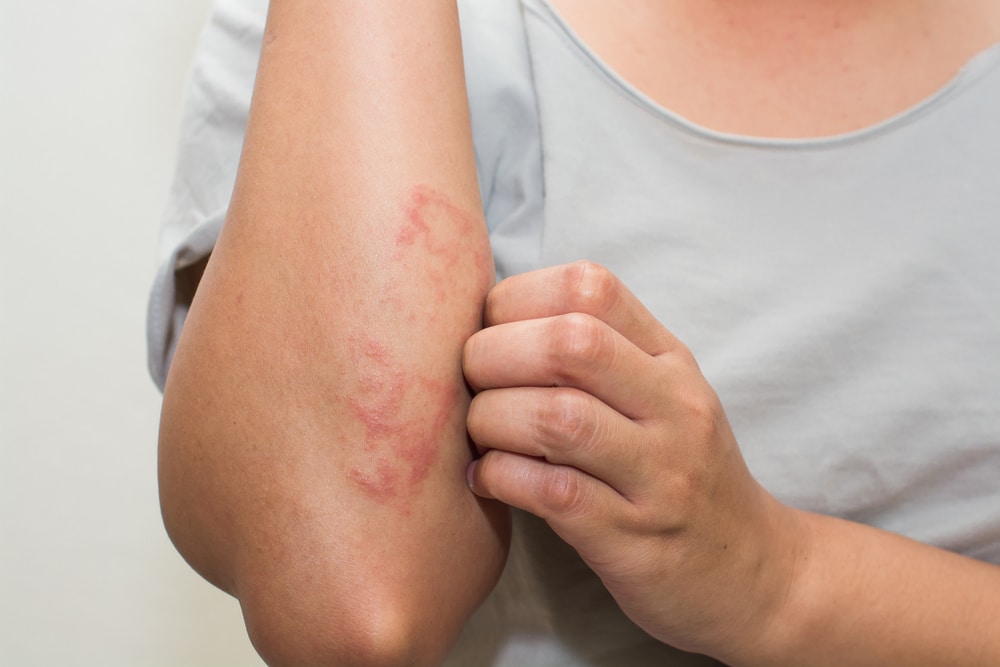  Dermatite: o que é e como tratar?