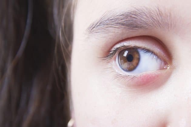  Olho inchado: quais as causas e tratamentos?