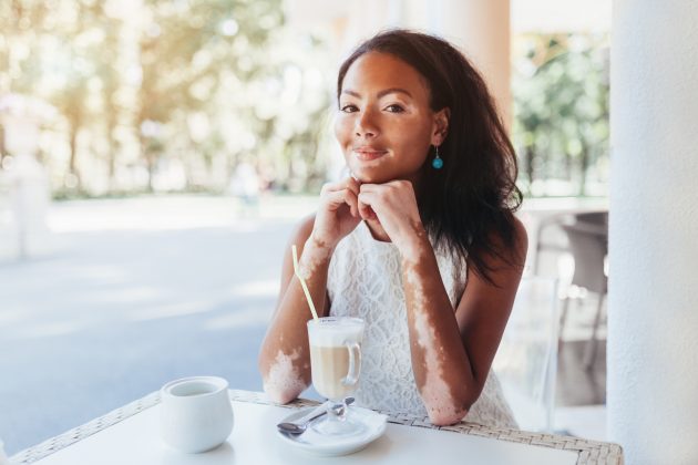  skin positivity vitiligo