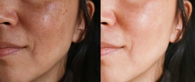 Melasma antes e depois 