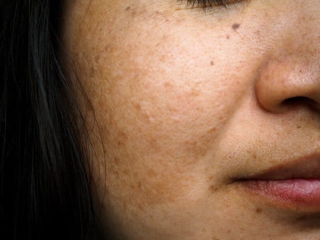 Melasma no rosto causas