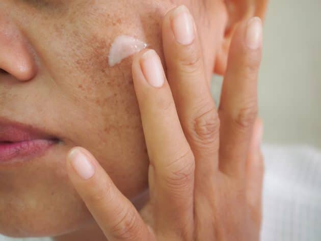 O que é bom para melasma?