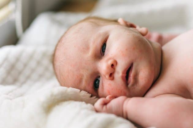 Acne Neonatal, Acne em bebês