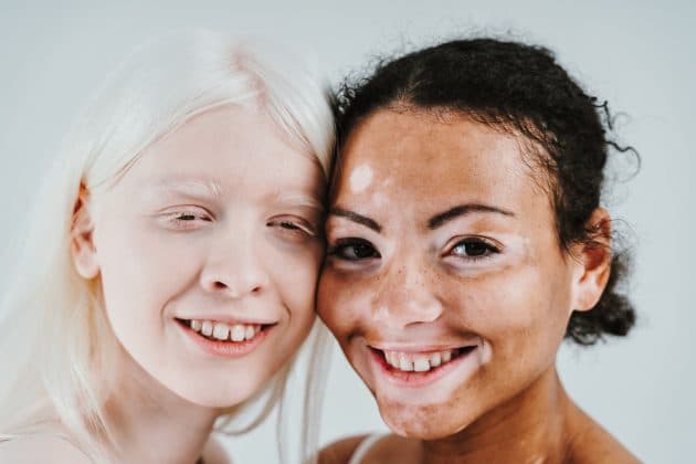 vitiligo falta de melanina