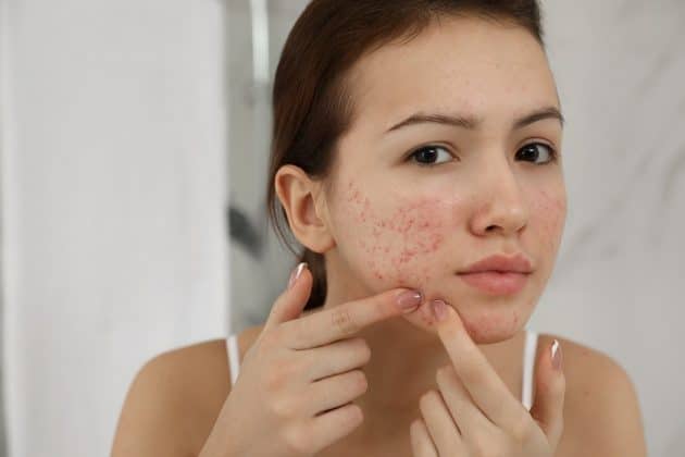 O que é uma acne pustulosa?